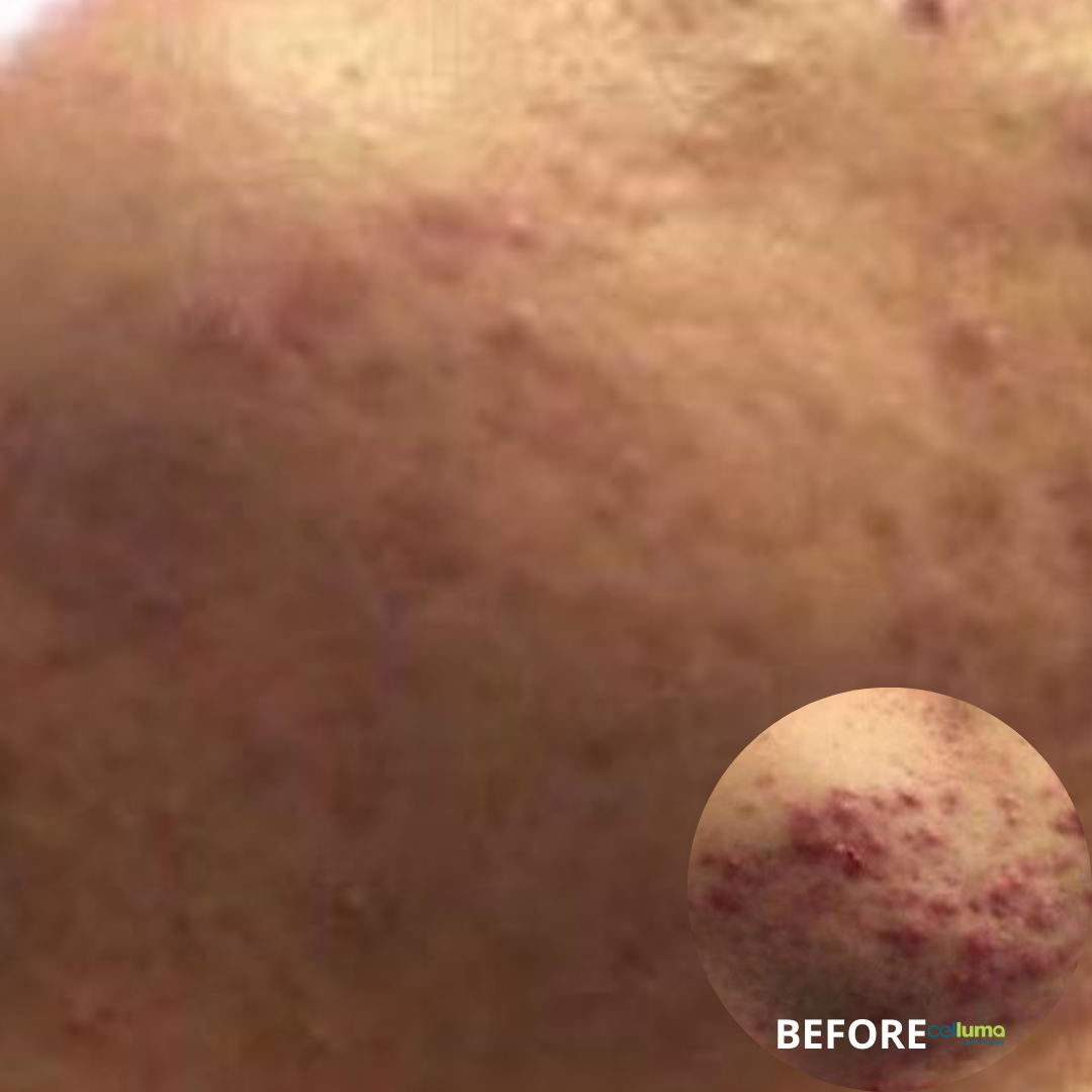 Celluma Light Therapy - Acne (1)