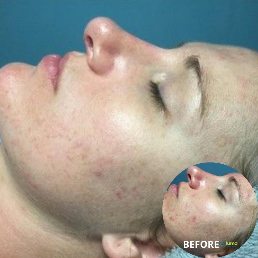 Celluma Light Therapy - Acne (2)
