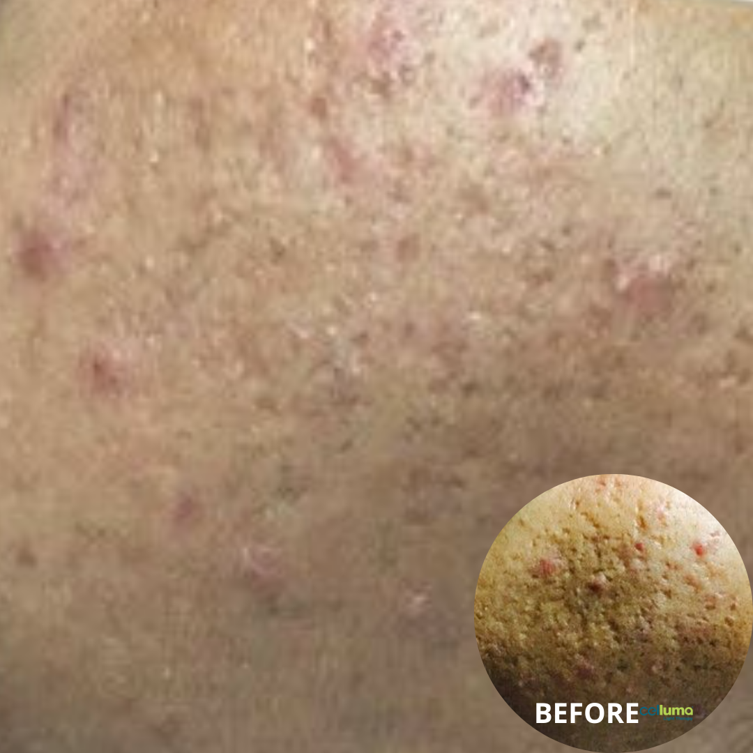 Celluma Light Therapy - Acne (4)