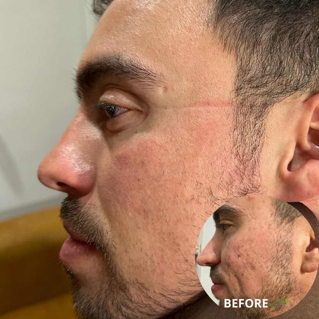 Celluma Light Therapy - Acne Scars