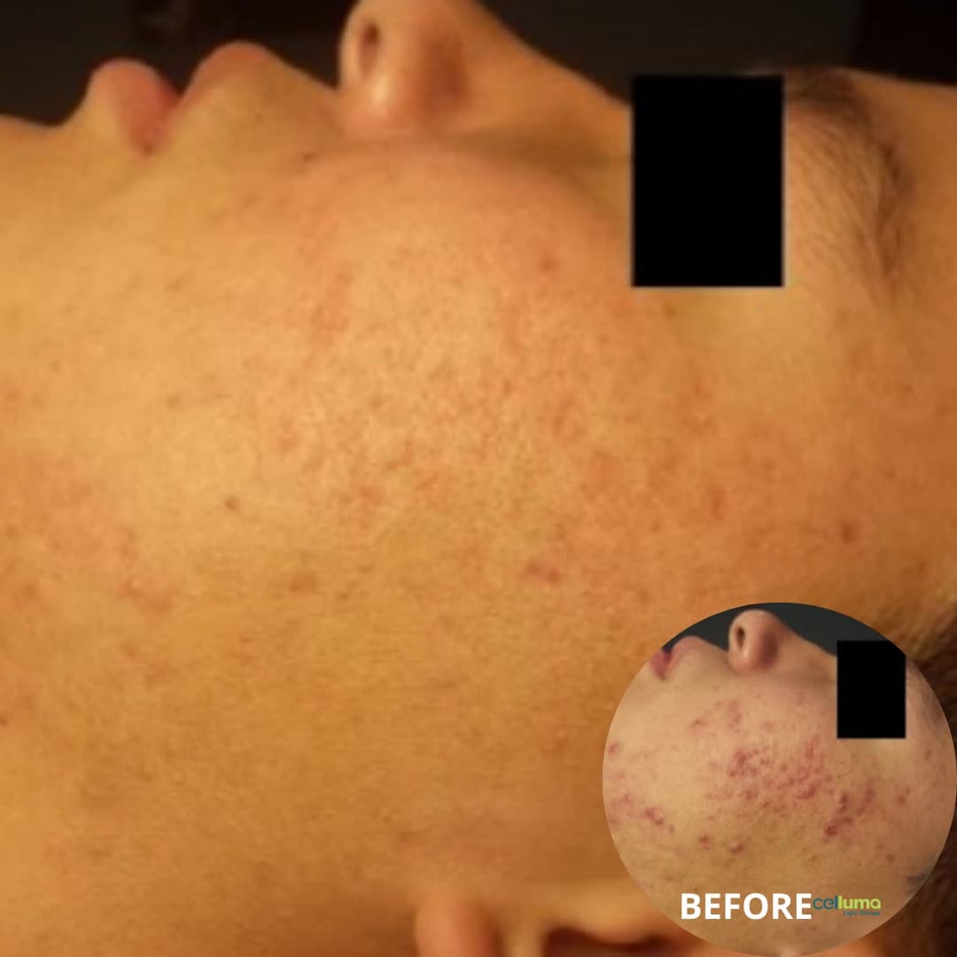 Celluma Light Therapy - Acne
