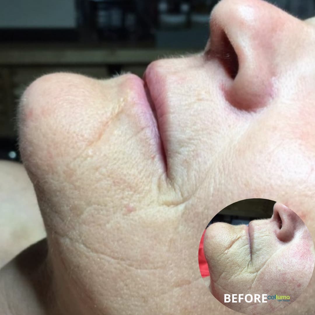 Celluma Light Therapy - Facial Scar