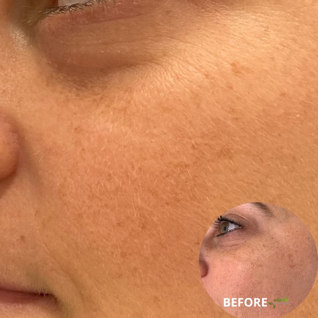 Celluma Light Therapy - Freckles