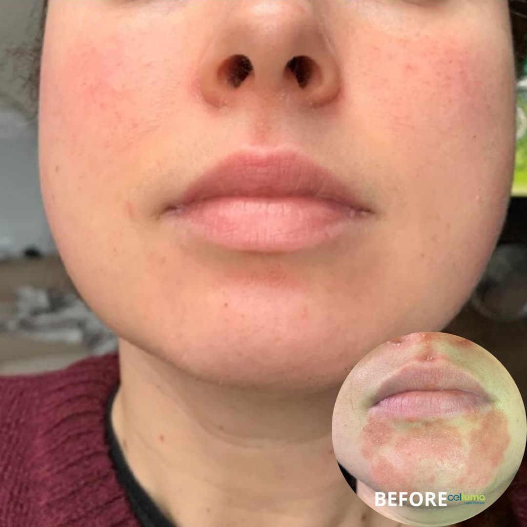 Celluma Light Therapy - Inflammation