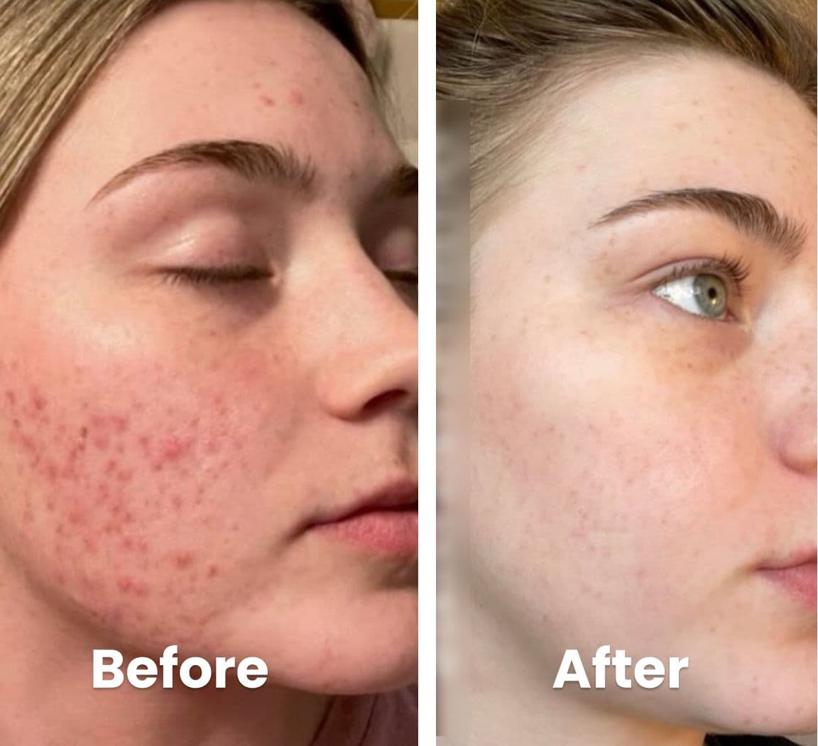 Acne scars
